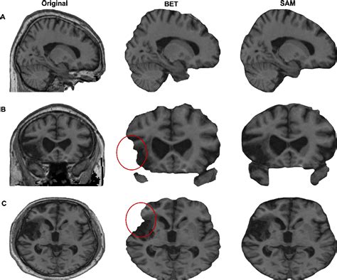 SAM Vs BET A Comparative Study For Brain Extraction And Segmentation