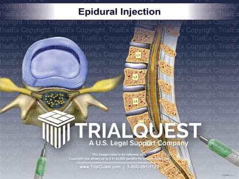 Epidural Injection - TrialExhibits Inc.