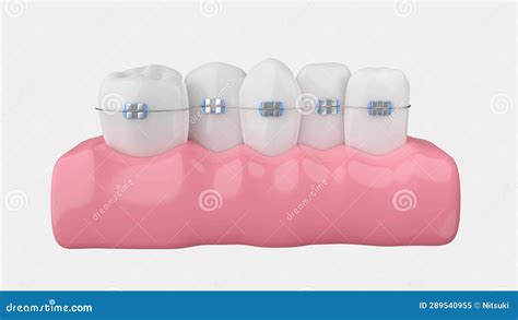 Overlapping Teeth with Straightening Treatment Stock Illustration - Illustration of braces ...