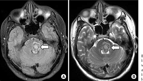 Figure 1 From Effect Of Ultrasonography Guided Botulinum Toxin Type A