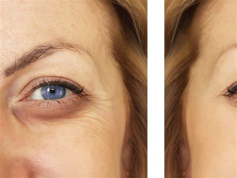 Top Five Reasons To Get Under Eye Filler Injections Peak Mens Health