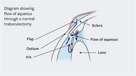 Trabeculectomy – Hashmanis Group of Hospital