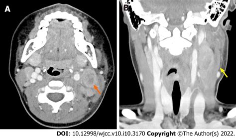 Lymph Node First Presentation Of Kawasaki Disease In A 12 Year Old Girl