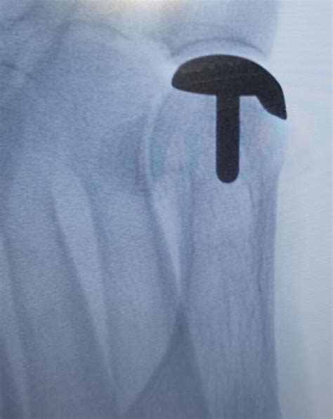 First Metatarsal Phalangeal Joint Replacement System: Motion Toe ...