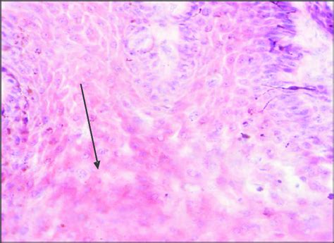 Intercellular Spongiosis | Download Scientific Diagram