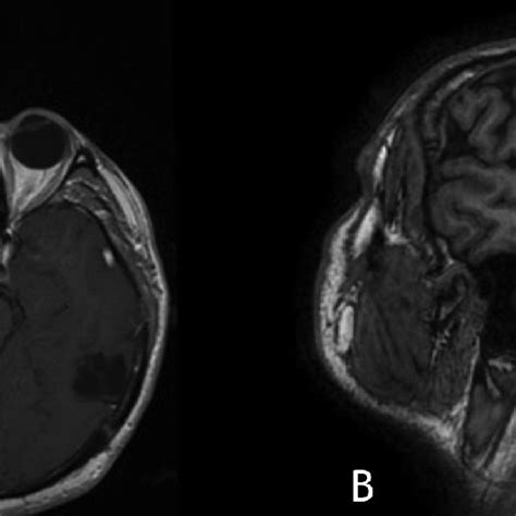 Late Postoperative Contrast Enhanced T1 Weighted Mri Images Download Scientific Diagram