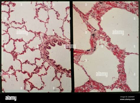 Emphysema And Normal Lung Tissue Light Micrograph In Normal Lung