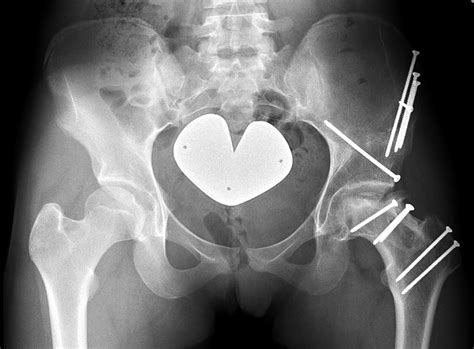 Case One Latest Follow Up Anteroposterior Pelvic Radiograph At Three