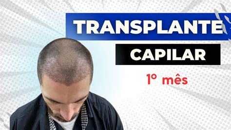 Tudo sobre meu 1 mês do Transplante capilar YouTube