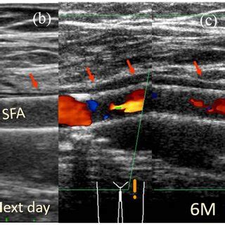 Seventy Two Year Old Male Treated With Viabahn Stent Graft A Viabahn