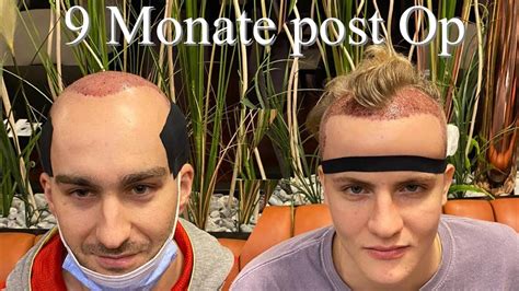 Monate Nach Der Haartransplantation In Istanbul Zwei Tolle