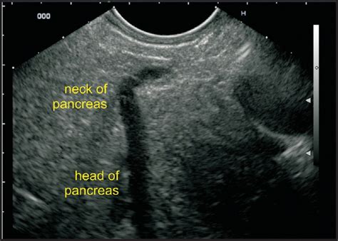 Pancreatic Divisum Ultrasound