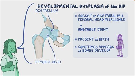 video developmental dysplasia   hip nursing osmosis