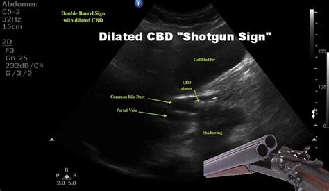 Common Hepatic Duct Ultrasound