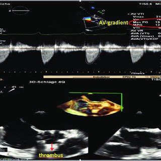 (A and B) Transoesophageal echocardiography with aortic valve gradient ...