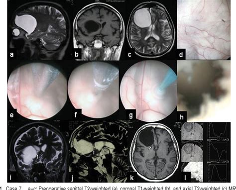 Figure 1 From Endoscopic Cystoventriculostomy For Treatment Of Paraxial