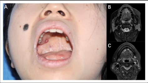 Figure From Surgical Resection Combined With Sclerotherapy Treating