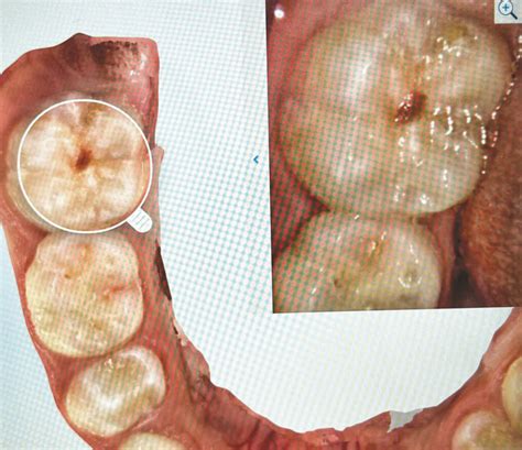 Clinical Pearl Steps For Intraoral Scanning Success Orthrodontic