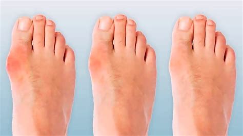 4 Ways To Ease Your Bunions Without Surgery YouTube