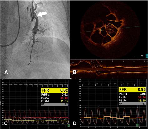 Refined Balloon Pulmonary Angioplasty Driven By Combined Assessment Of