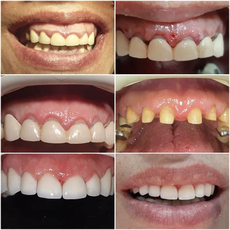 Cases Hollywood Smile Design Salloum Dental Clinic