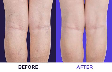 Varicose Veins Nottingham Vascular Surgery