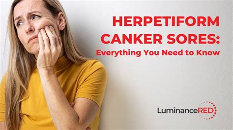 Herpetiform Canker Sores Everything You Need To Know YouTube