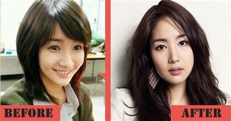 Park Min Young Before And After Nose Job