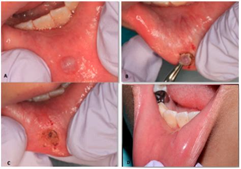 Dentistry Journal Free Full Text Treating Mucocele In Pediatric