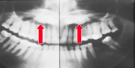 1 Benign Tumors Of Jaws Non Odontogenic Flashcards Quizlet