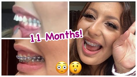 11 Months With Braces Overjet Correction With No Extractions Damon