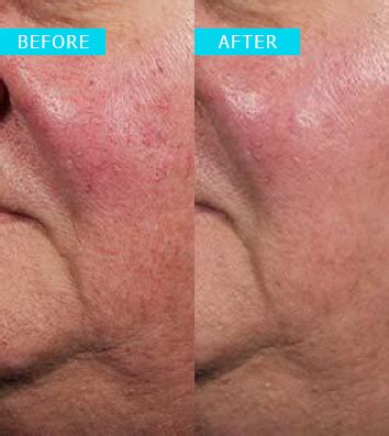 Excel V Laser Treatment Westridge Medical Laser Removal