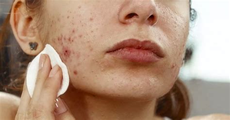 How To Treat Adult Acne And Banish Your Breakouts Rsvp Live