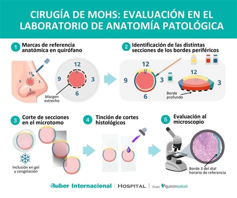 Cirugía De Mohs Tratamiento Del Carcinoma Basocelular En La Piel De La