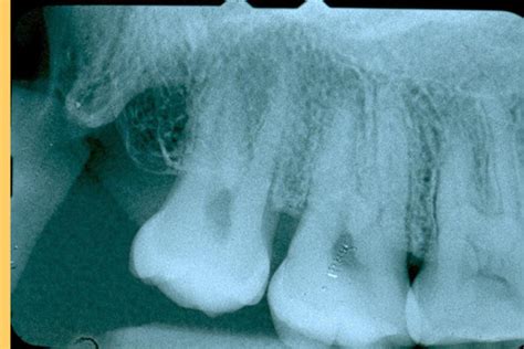 Dental Radiograph Errors Flashcards Quizlet