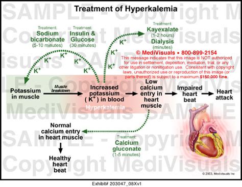 Treatment of Hyperkalemia Medical Illustration Medivisuals