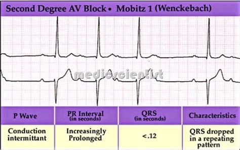 Second Degree Atrioventricular Block Wikipedia