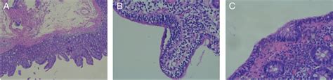 A Duodenal Slice Showing Villous Atrophy Consistent With Marsh