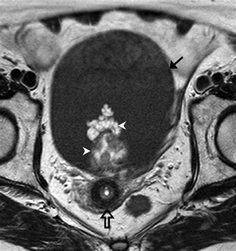 Borderline Tumors Of The Ovary Ct And Mri Features And Tumor Markers In Differentiation From