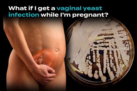 Vaginal Yeast Infection In Pregnancy Heres How To Prevent And Treat