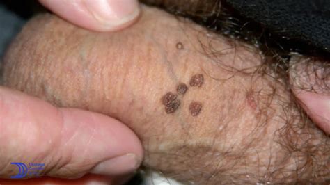 Verrugas Hpv En Hombres Causas S Ntomas Tratamiento Y Prevenci N