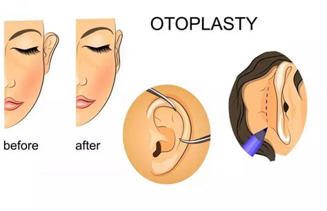 Ear Pinning Otoplasty Dr Jonathan Harounian