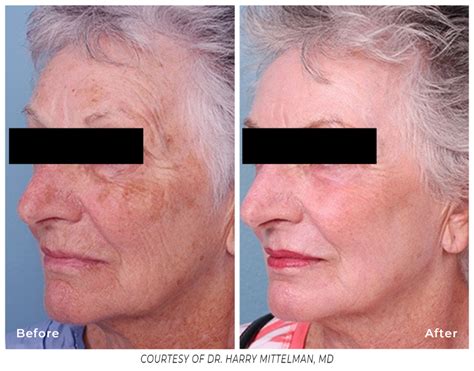 Erbium Laser Resurfacing Scientiphika Medspa Rhode Island