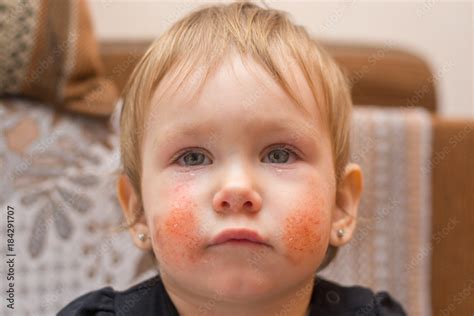 Cute Child 1 2 Years Old With Eczema Or Allergic Rash On His Face