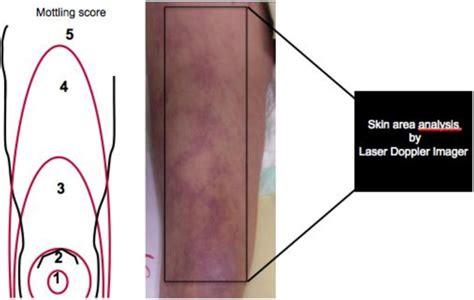 Alteration Of Skin Perfusion In Mottling Area During Septic Shock Annals Of Intensive Care