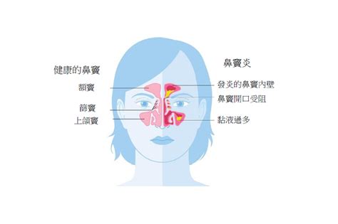 慢性鼻竇炎伴鼻瘜肉 鼻敏感患者是高危？耳鼻喉科專科醫生分享症狀及治療方法 Crs Nasal Polyps Severe Asthma