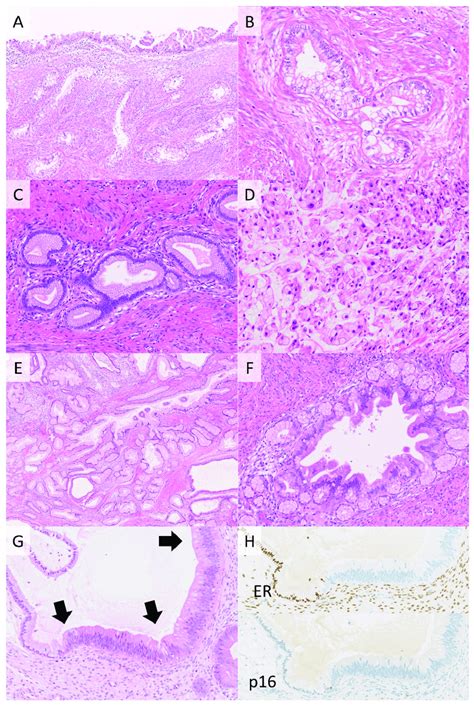 Gastric Type Adenocarcinoma Gas Of The Cervix Gas Is A Download