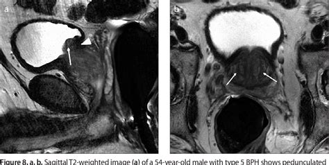 Figure 8 From Magnetic Resonance Imaging Of Benign Prostatic Hyperplasia Semantic Scholar