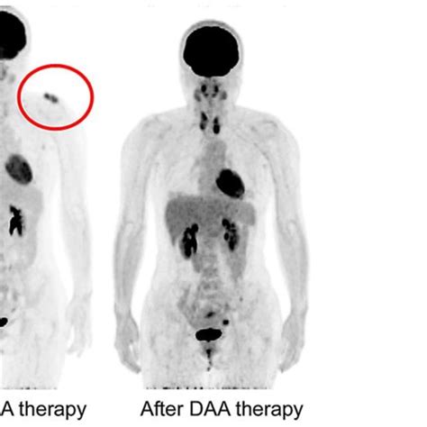 18 F Fluorodeoxyglucose Positron Emission Tomography With Computed