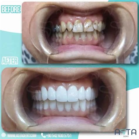 Best Turkish Veneers Veneers In Turkey At Best Price